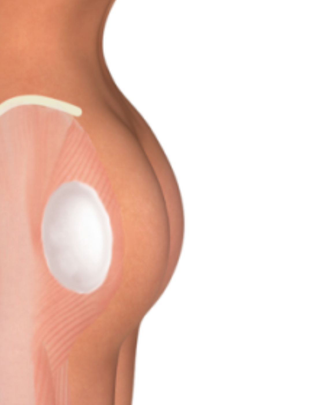 Implant fesier – Augmentare fesieră cu implanturi