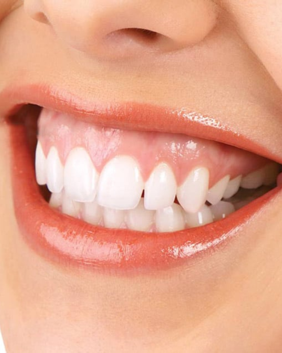 Tratamentul Zâmbetului Gingival