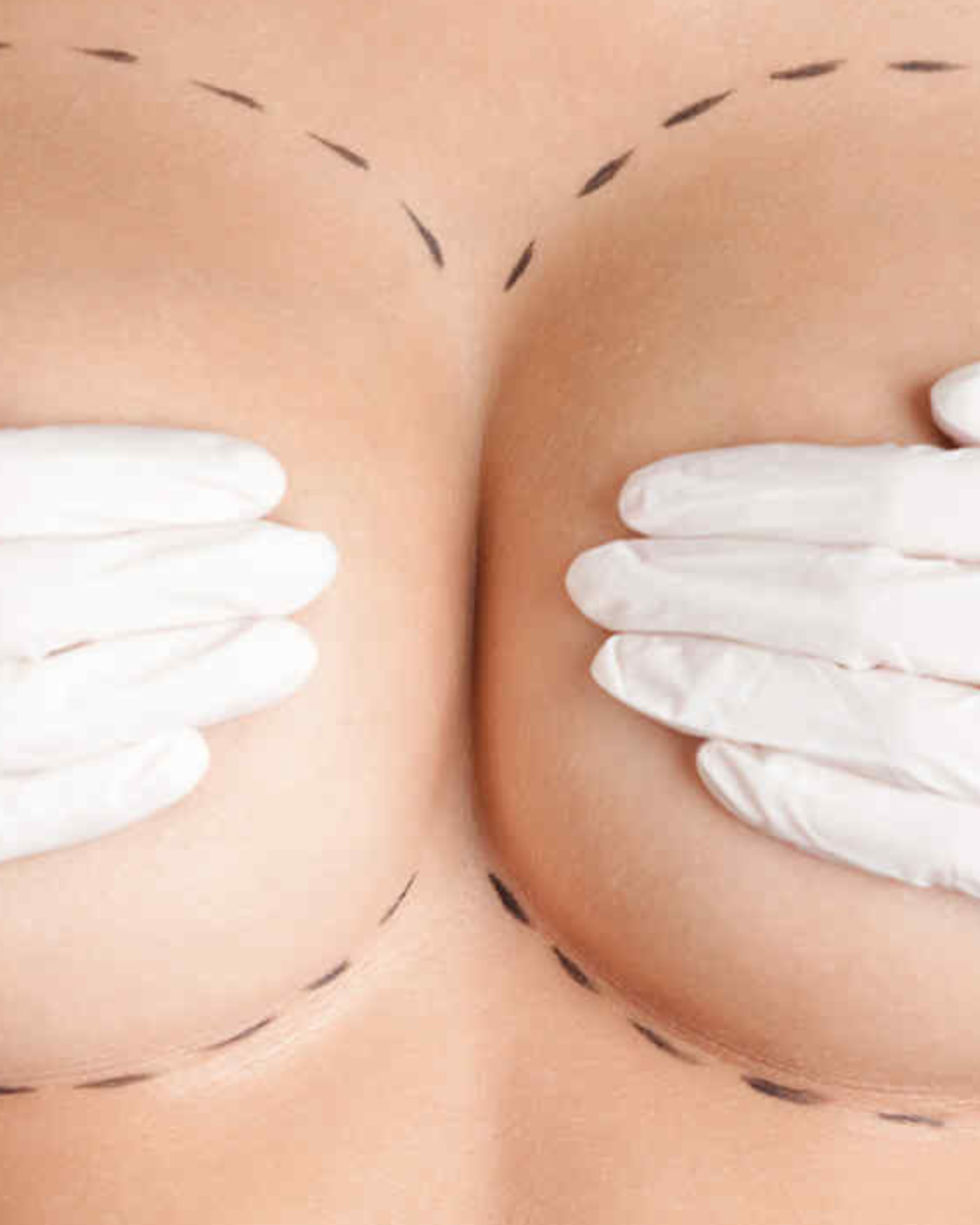 Mărirea sânilor prin lipofilling – Transfer de grăsime proprie