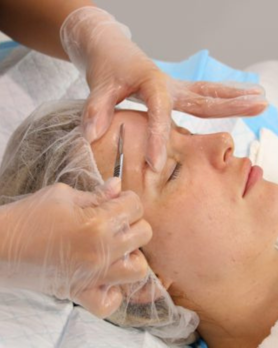 Dermaplaning – Față completă