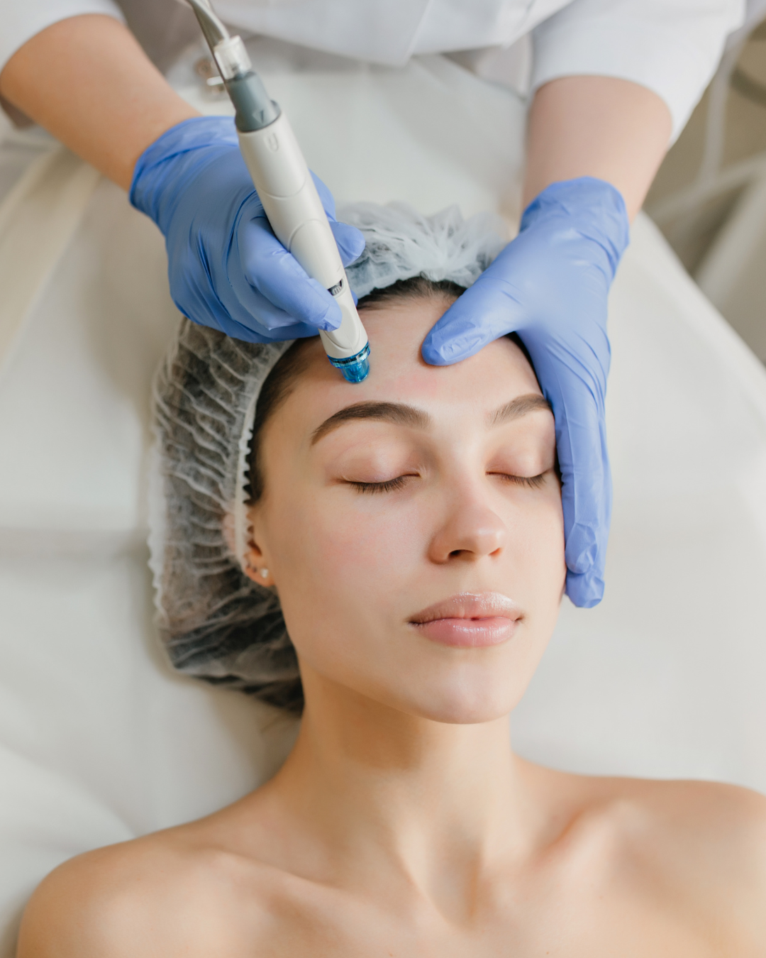 Microneedling – Zonă corporală (A5)
