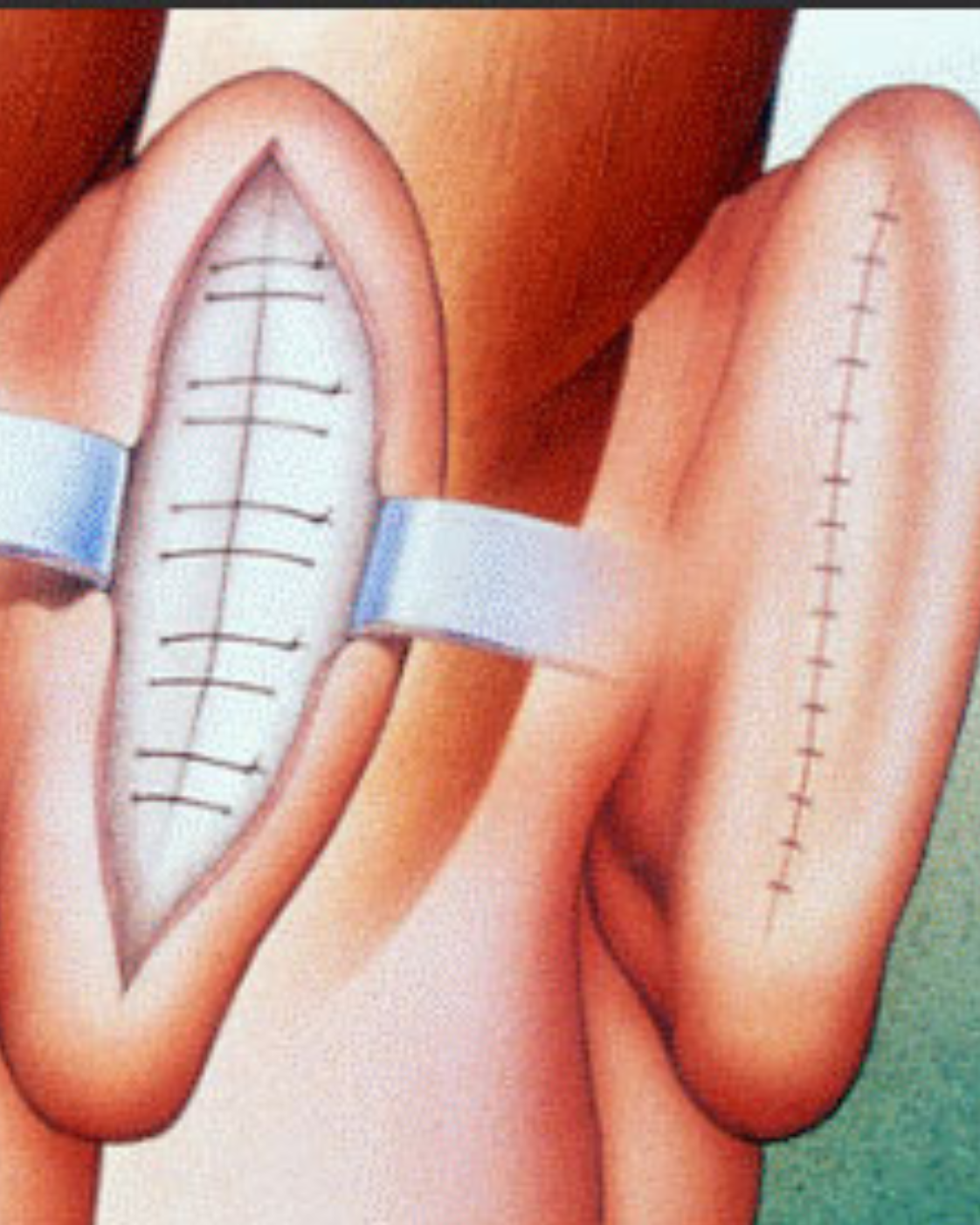 Otoplastie – Corectarea urechilor proeminente