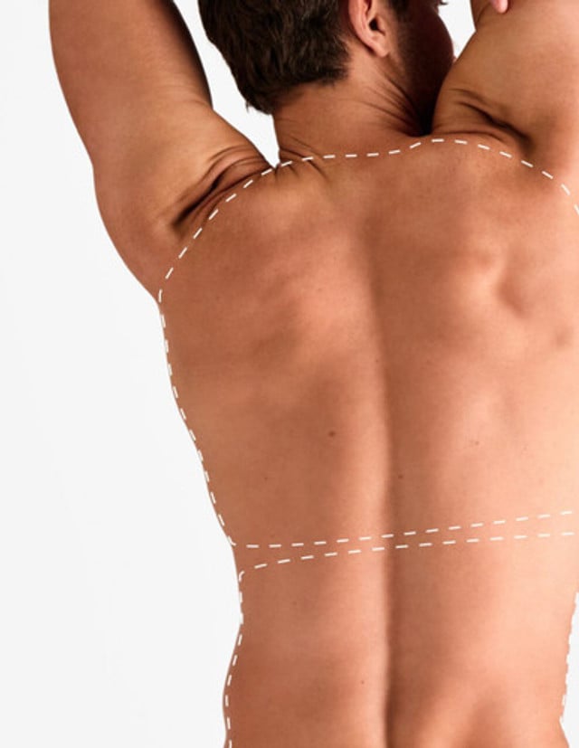 Spate 1/2 – Epilare Definitivă cu Laser