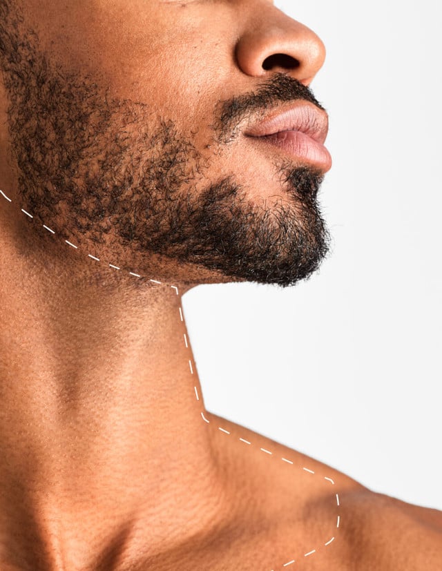 Gât (Partea Frontală)-Epilare Definitivă cu Laser