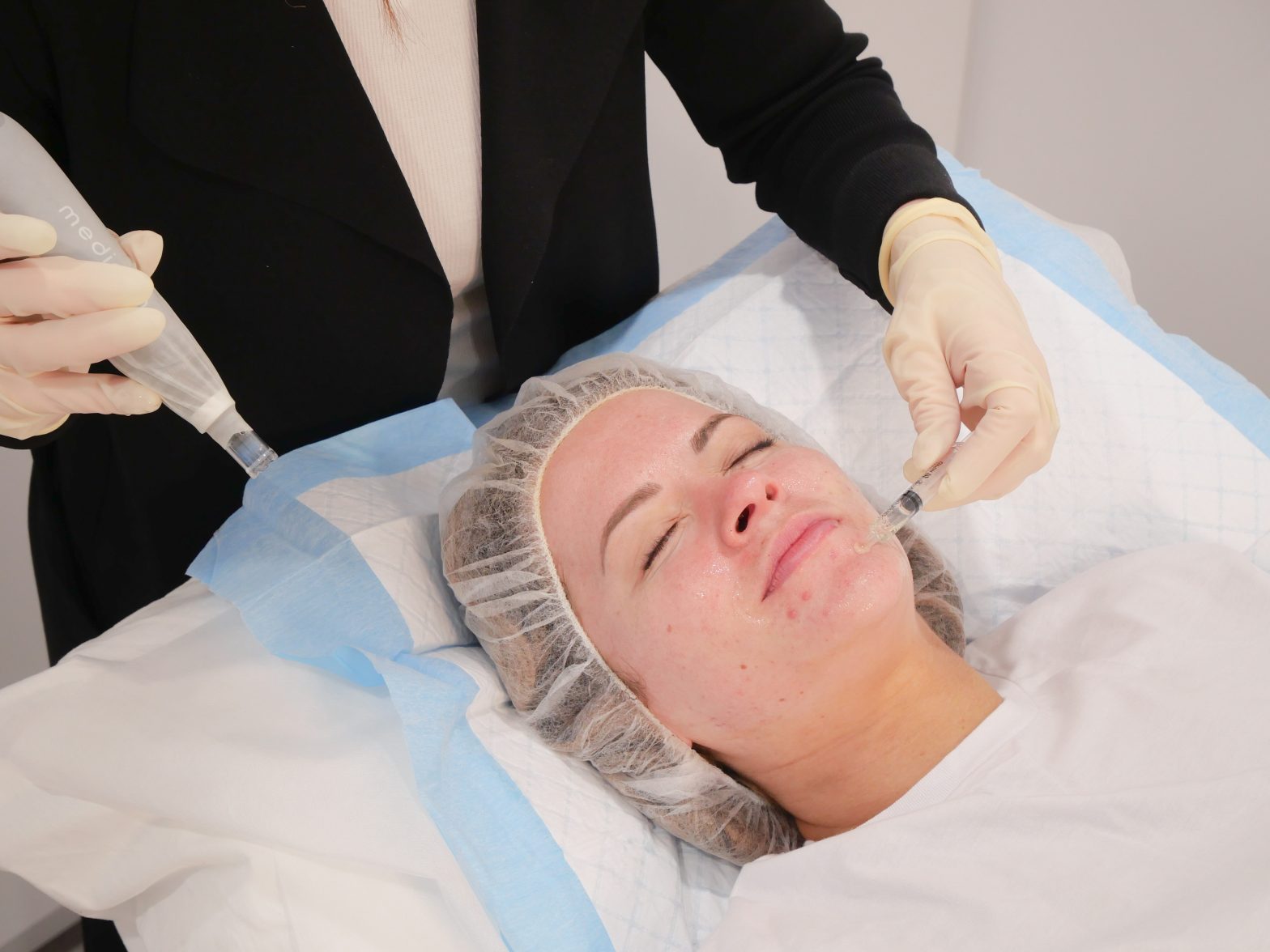 Microneedling – Abdomen