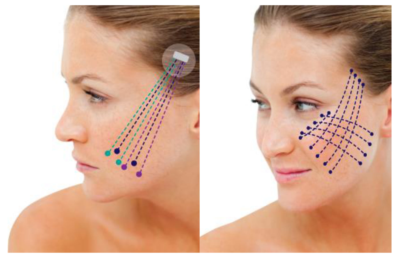 Lifting non-chirurgical & fermitate naturală