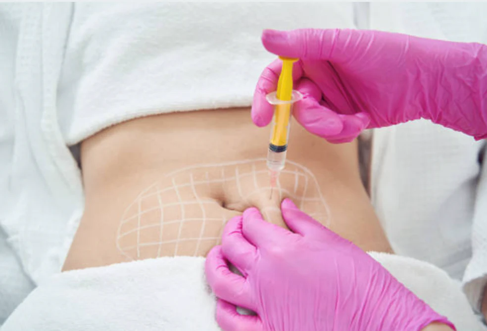 Lipoliză injectabilă – topirea grăsimii corporale localizate