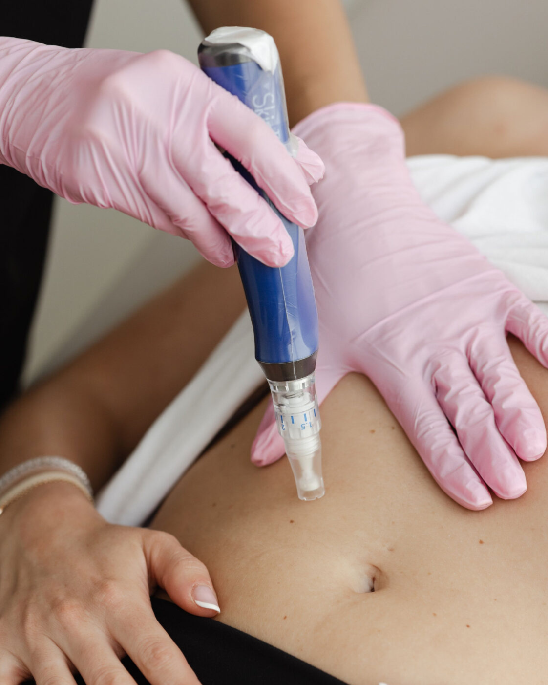 Microneedling – Abdomen
