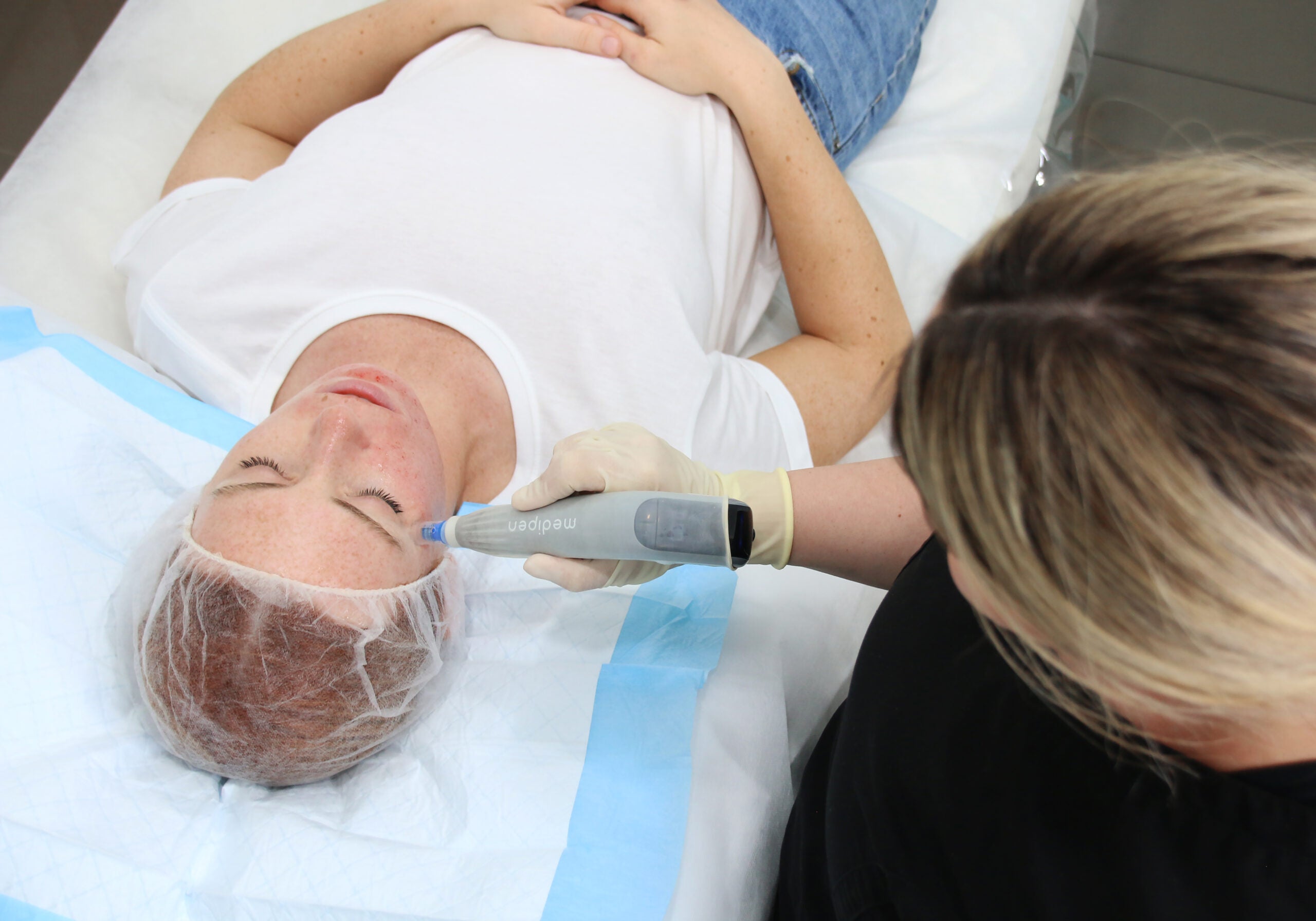 Microneedling – Zonă corporală (A5)